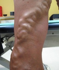 Larger varicose veins