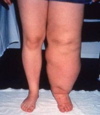 Lymphedema